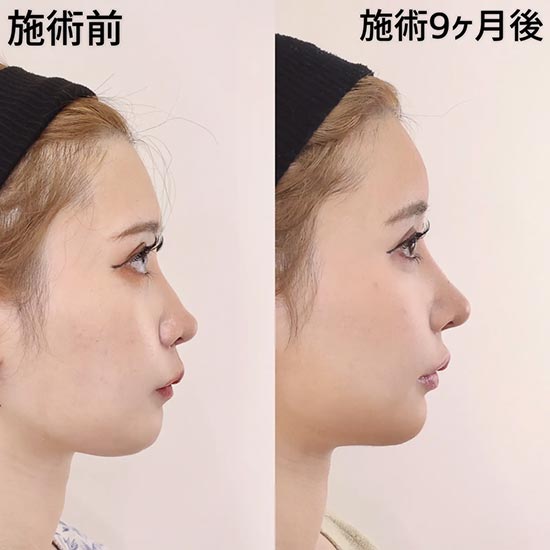 TAクリニックの鼻中隔延長＋鼻尖形成＋軟骨移植＋プロテーゼ＋コンデンスリッチ脂肪注入(額・こめかみ)の症例