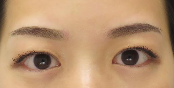 クレアージュ東京の眉毛3回（コンビネーション）の症例