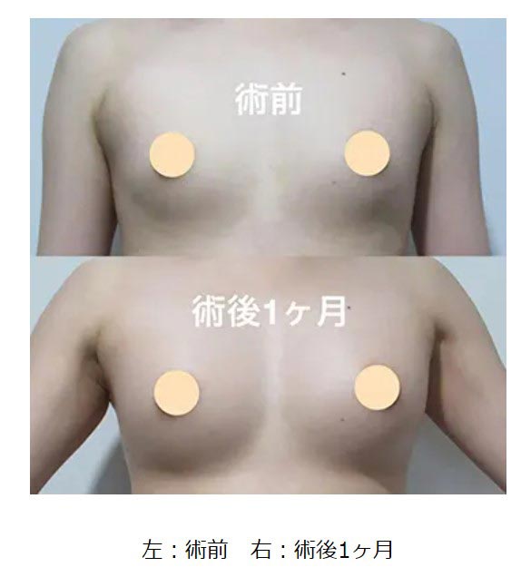 共立美容外科の豊胸手術の症例