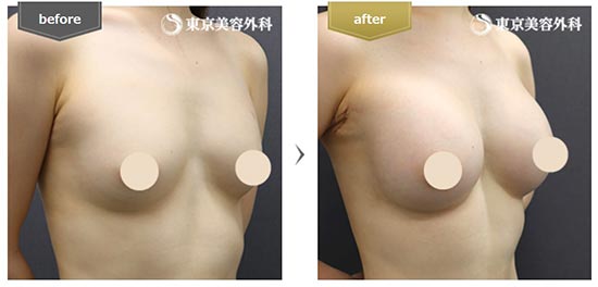 東京美容外科の豊胸手術の症例