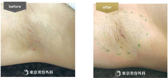 東京美容外科のワキガの手術の症例