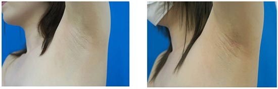TCB東京中央美容外科のワキガ治療（吸引シェービング法・剪除法）の症例