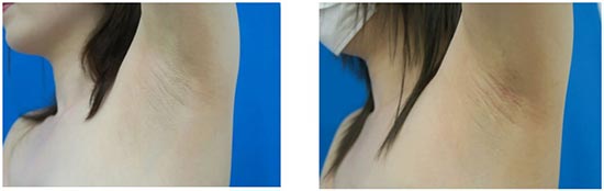 TCB東京中央美容外科のワキガ治療（吸引シェービング法・剪除法）の症例