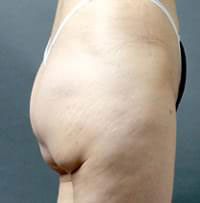 脂肪吸引症例