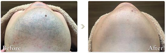 レイロールのヒゲ脱毛(全8カ所)セット 2年通い放題の症例