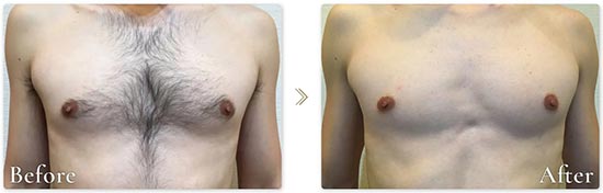 レイロールの胸・お腹脱毛セット 2年通い放題の症例