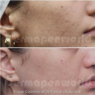 CLASSY 仙台美容外科・美容皮膚科のダーマペンの症例