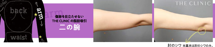 二の腕の脂肪吸引の傷跡写真
