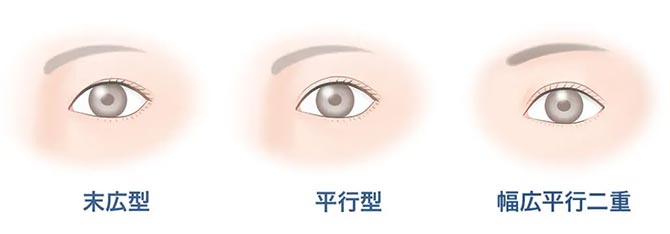 二重整形のデザイン(末広型・平行型・幅広平行二重)