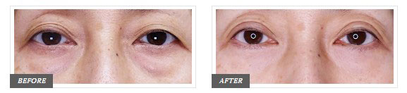TCB東京中央美容外科の切開法による目の下のたるみ取り（下眼瞼除皺術）の症例