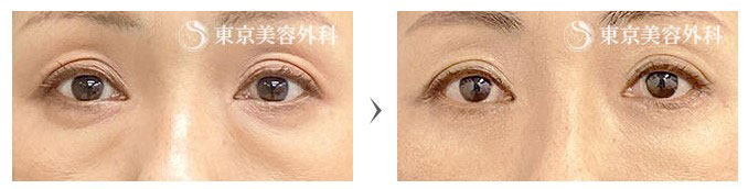 東京美容外科の目の下のたるみ取り（ハムラ法、皮膚切除）の症例写真の症例