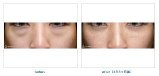 聖心美容クリニックの目の下の脂肪取り（経結膜下脱脂法）+プレミアムPRP皮膚再生療法の症例