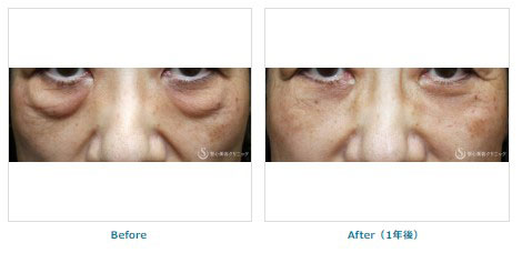 聖心美容クリニックの下眼瞼切開術/下眼瞼除皺術/ハムラ法＋プレミアムPRP皮膚再生療法の症例