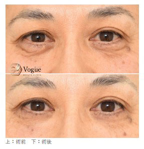 札幌ル・トロワビューティクリニックVogueの下眼瞼たるみ取り＋眼窩脂肪除去＋眼輪筋切除の症例