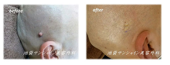 池袋サンシャイン美容外科のいぼ除去（保険治療）の症例