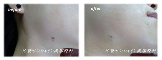池袋サンシャイン美容外科のほくろ除去（保険治療）の症例