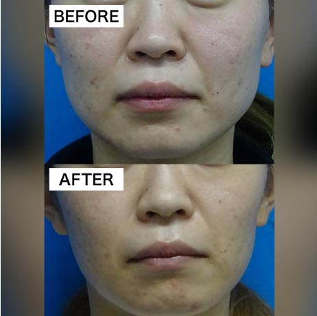 TCB東京中央美容外科のエラのボトックス小顔注射の症例