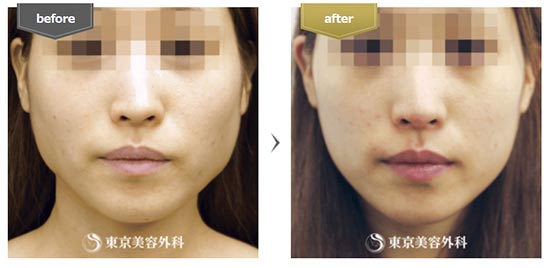 東京美容外科のエラボトックスの症例