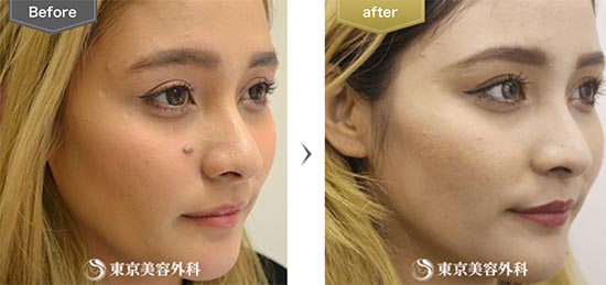 東京美容外科の切開縫合の症例