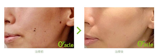 オラクル美容皮膚科のCO2炭酸ガスレーザの症例