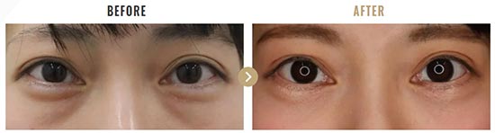 TAクリニックの下眼瞼切開術の症例