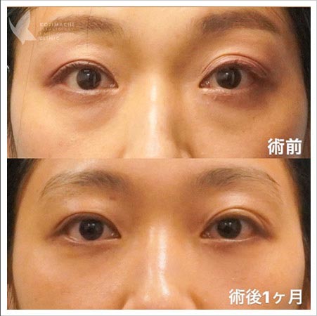 麹町皮ふ科・形成外科クリニック/BIOTOPE CLINICの目の下のクマ取り（裏ハムラ法）の症例