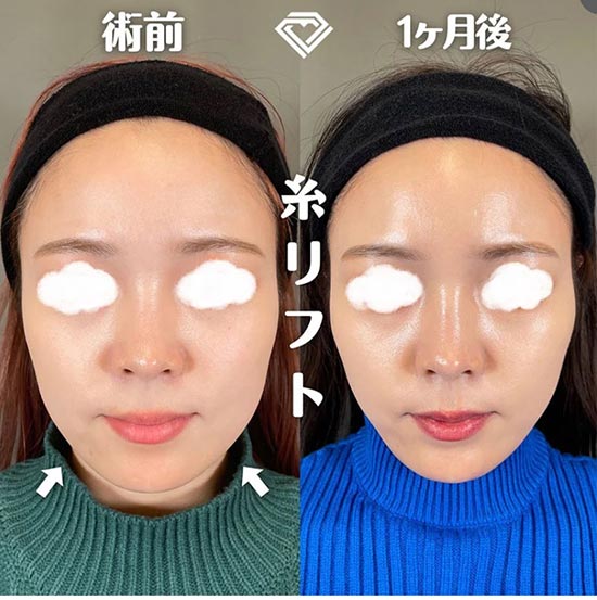 TCB東京中央美容外科のTCB式小顔美肌再生 1本の症例