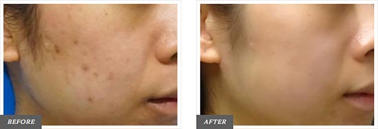 TCB東京中央美容外科のサブシジョン（最新クレーター治療）の症例