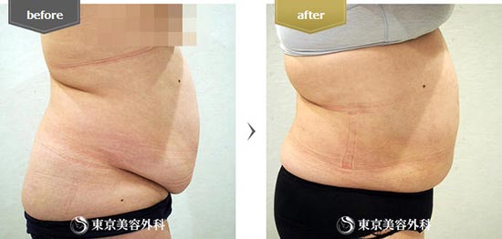 東京美容外科の脂肪吸引（腹部）の症例
