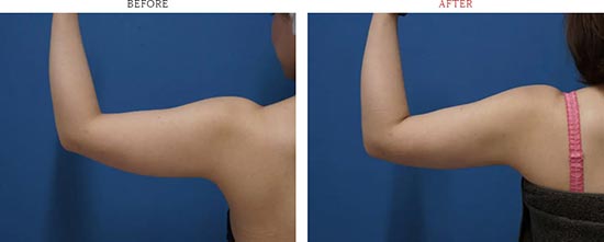 もとび美容外科クリニックの二の腕・肩脂肪吸引　１ヶ月後の症例