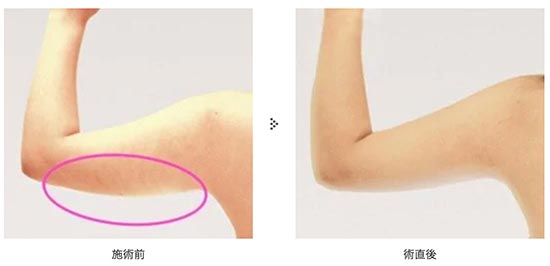共立美容外科の二の腕　脂肪吸引の症例