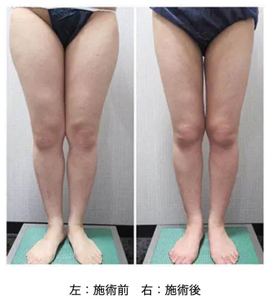 共立美容外科の臀部・太もも　脂肪吸引の症例