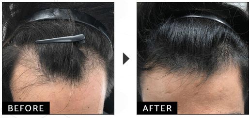 ウィルAGAクリニックの発毛トータルエクストラコースの症例