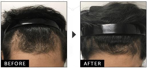 ウィルAGAクリニックの発毛トータルエクストラコースの症例