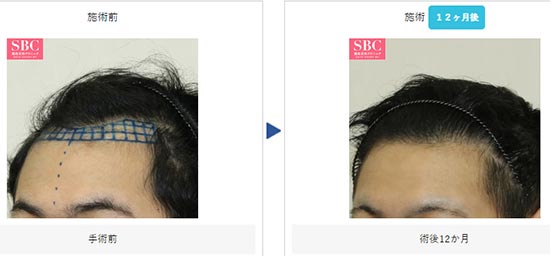 湘南美容クリニックのAGA薄毛治療 + 自毛植毛の症例