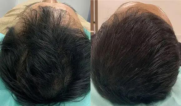 麹町皮ふ科・形成外科クリニック/BIOTOPE CLINICの薄毛AGA再生治療の症例