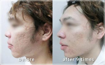 共立美容外科のニキビ、ニキビ跡治療の経過の症例