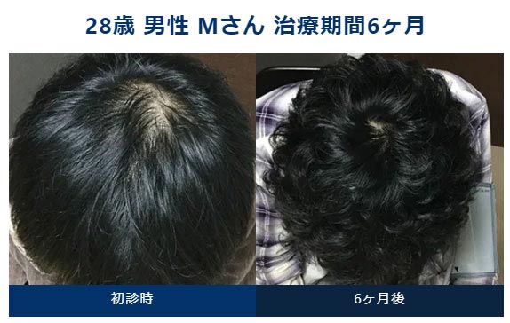 AGAメディカルケアクリニックのオリジナル発毛治療＋メディカルケア発毛メソセラピーの症例