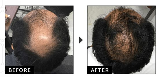 ウィルAGAクリニックの発毛トータルエクストラコースで内服薬＋最新LHDV頭皮注入治療（治療期間2年）の症例