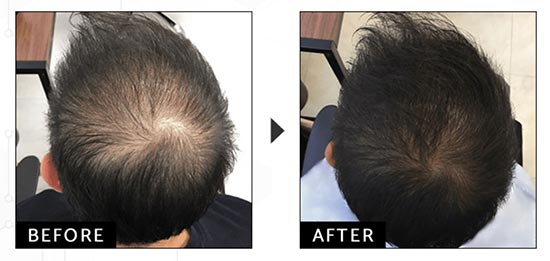 ウィルAGAクリニックの発毛トータルDXコースで内服薬＋最新LHDV頭皮注入治療（治療期間1年）の症例