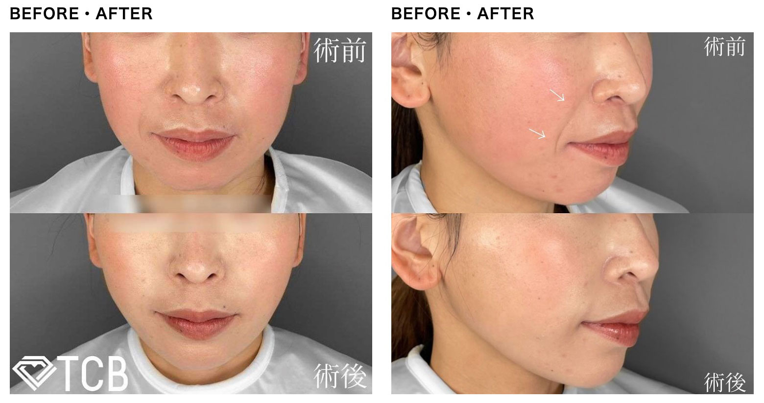TCB東京中央美容外科の糸リフト「TCB小顔リフト」の症例