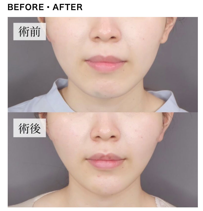 TCB東京中央美容外科の糸リフト「TCB式小顔美肌再生」の症例