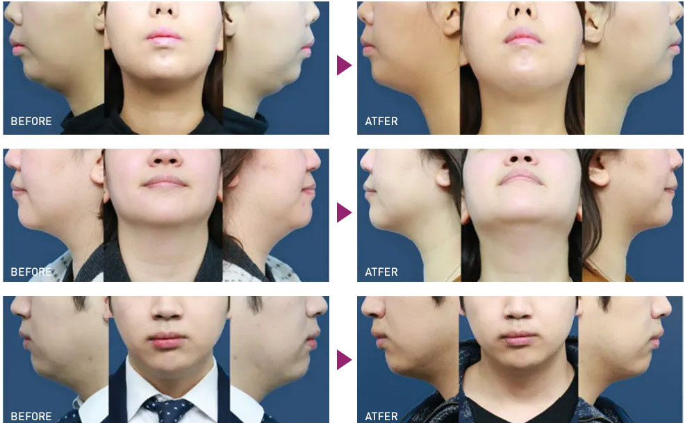 港区エリアの脂肪溶解注射を受けられるおすすめのクリニック10選 美容医療の病院選び