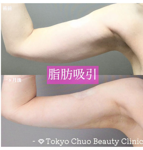 TCB東京中央美容外科の二の腕・肩の脂肪吸引の症例
