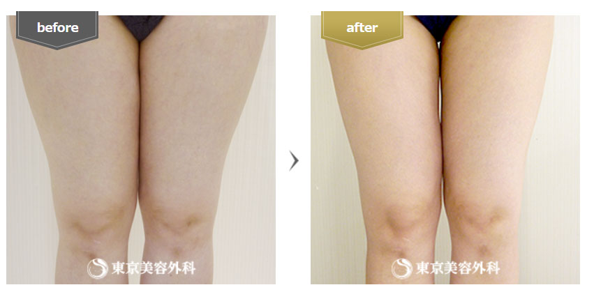 東京美容外科の大腿部の脂肪吸引の症例