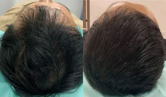 BIOTOPE CLINICの薄毛AGA再生治療の症例