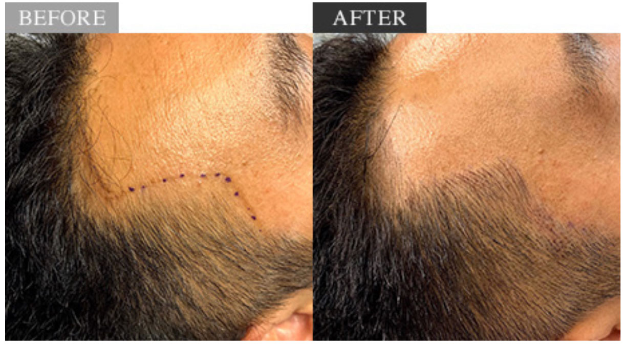 AMGヘアアートメイクのAGA治療の症例